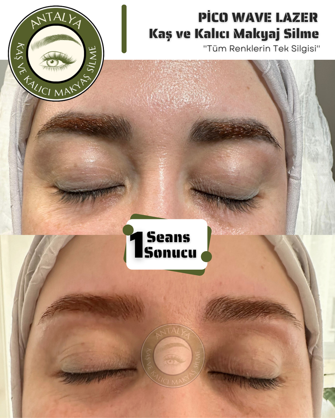 Kaş Boyası Silme Sonrası Günlük Hayata Devam Edilebilir mi? – Antalya Dövme Silme Merkezi