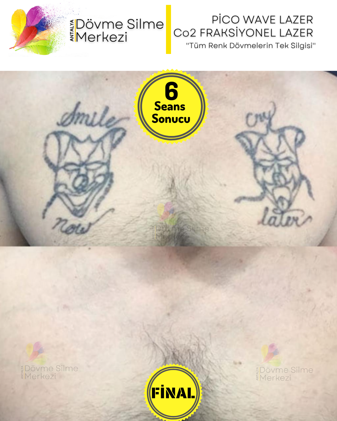 Antalya Dövme Silme