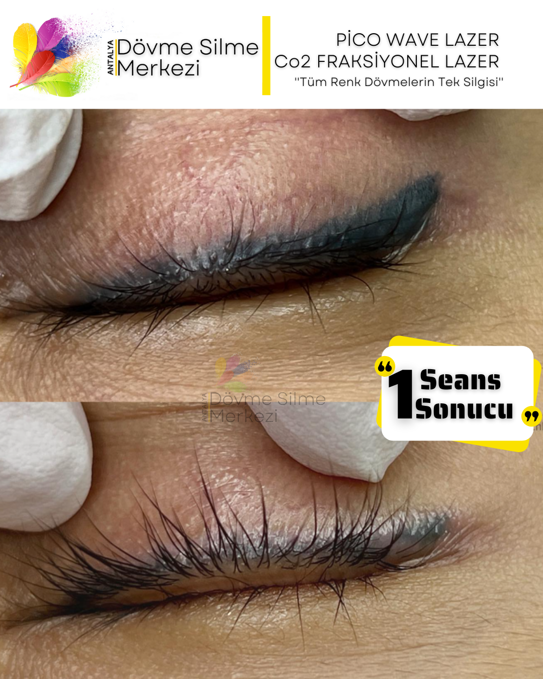 Kalıcı Eyeliner Silme İşlemi Göze Hiçbir Zarar Vermeden Nasıl Gerçekleştirilir?