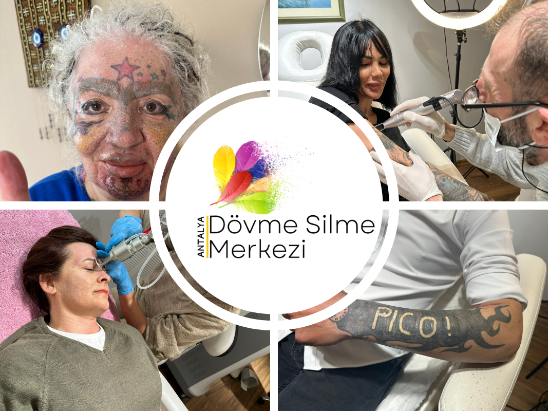 Antalya Dövme Silme