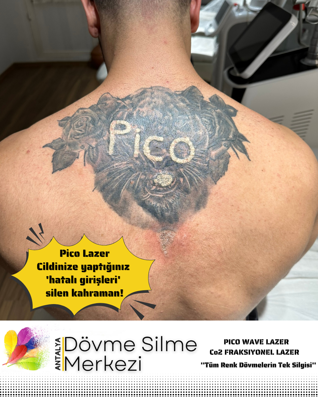 Bir Dövmeye Silme İşlemi Yapıldıktan Sonra Üzerine Yeniden Dövme Yapılabilir mi?
