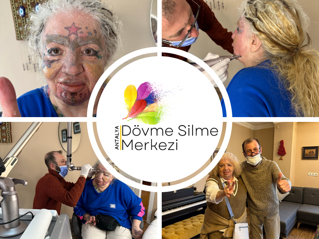 Antalya Dövme Silme