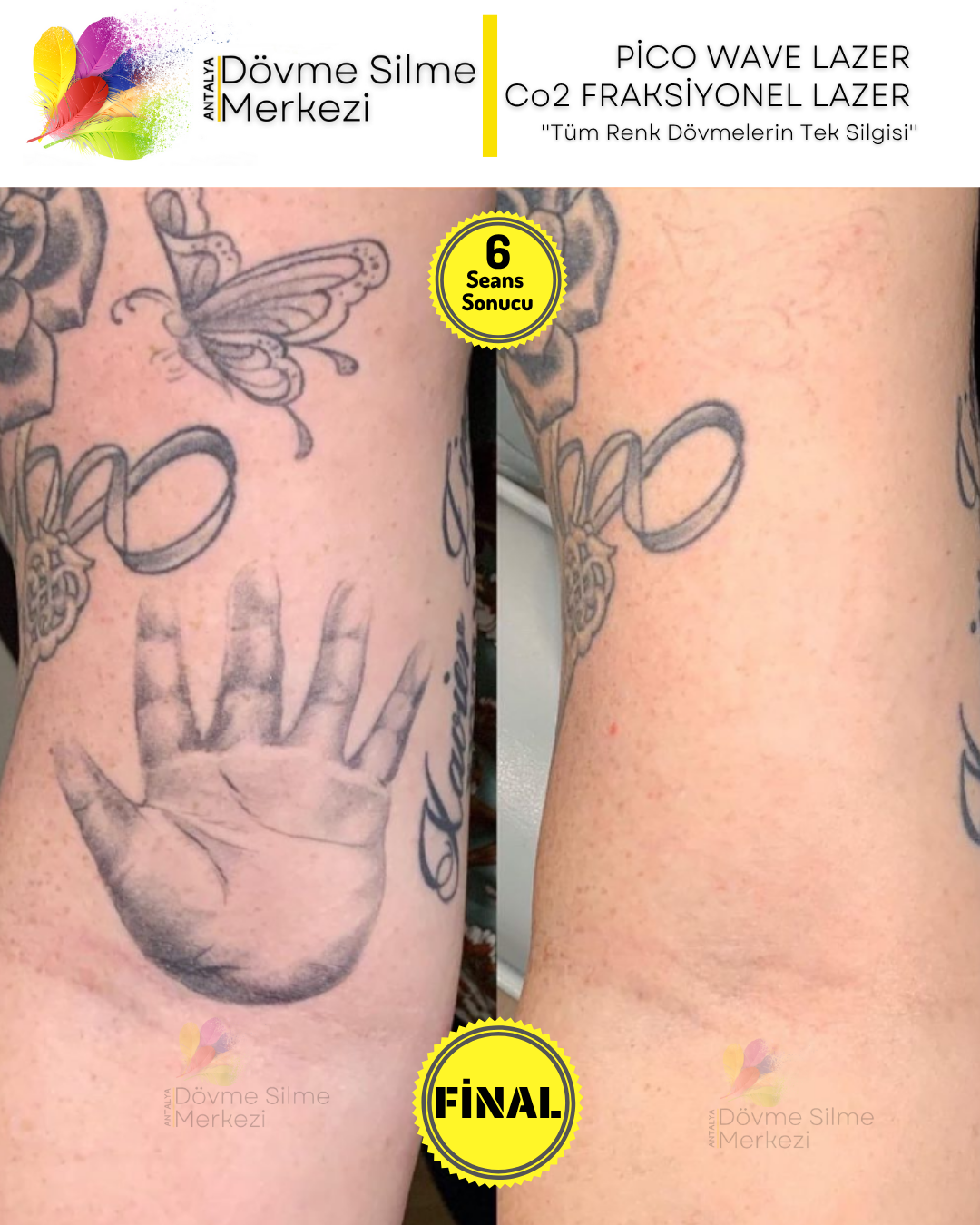 Dövme Yapılırken Kullanılmış Olan Boya Türü, Silme İşleminin Sürecini Etkiler mi?