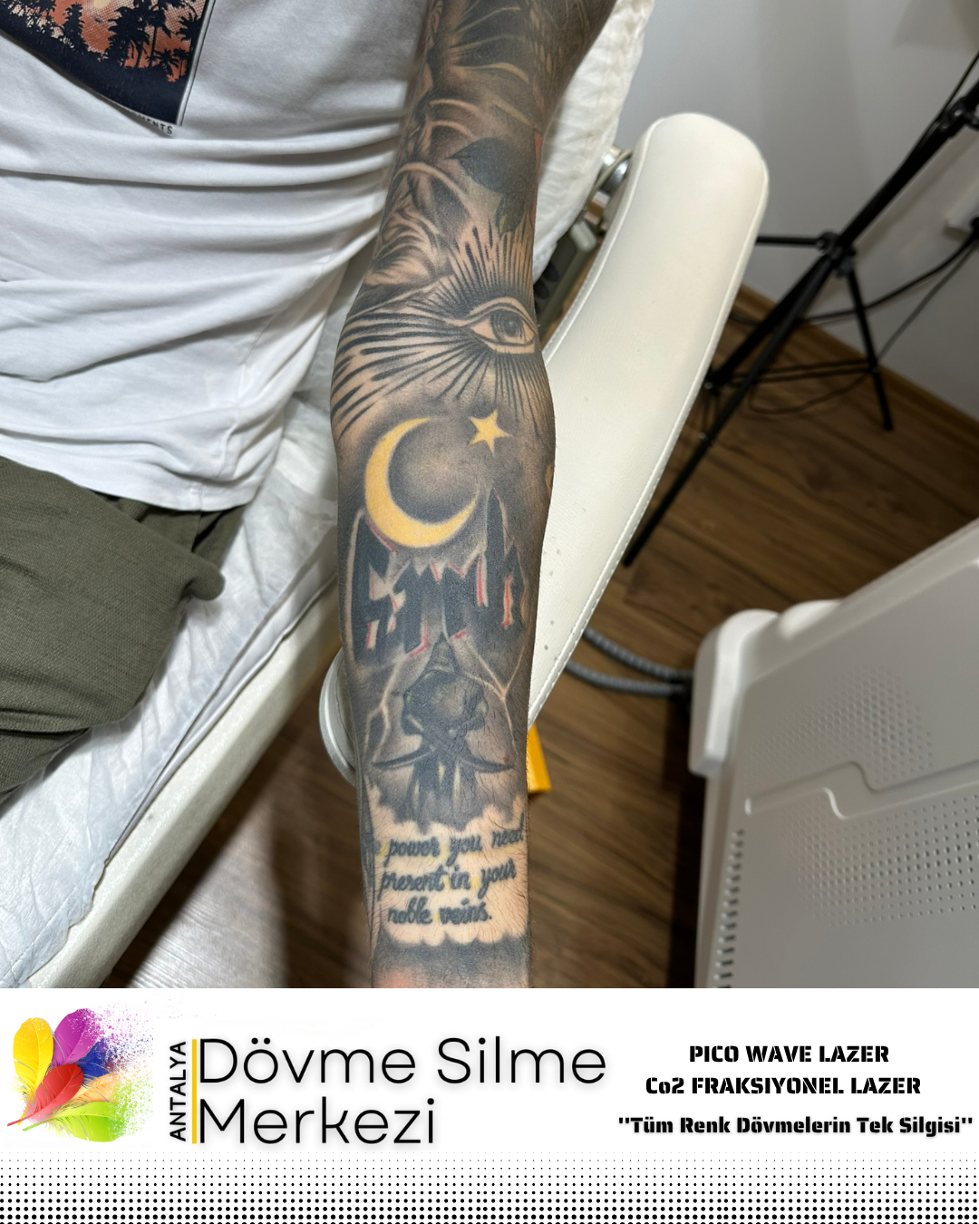 Dövme Silme Sürecinin Hangi Aşamasından Sonra Güneşlenme Cilde Zarar Vermez?